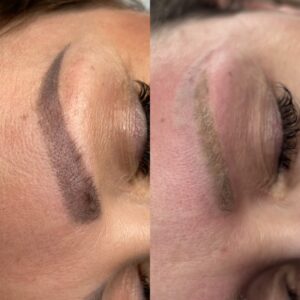 laserowe usuwanie brwi permanentnych