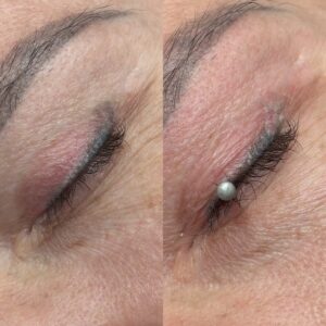 laserowe usuwanie kreski permanentnej